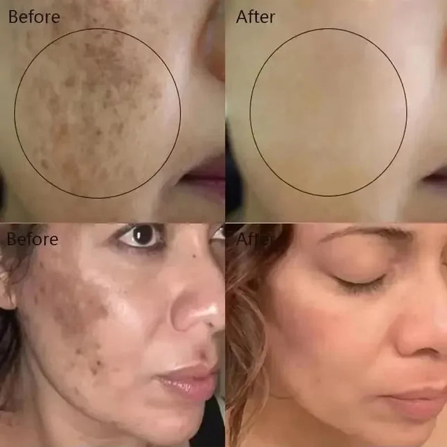 Vitamin C Whitening Serum – Dark Spot & Freckle Remover - Glossorea