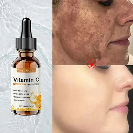 Vitamin C Whitening Serum – Dark Spot & Freckle Remover - Glossorea