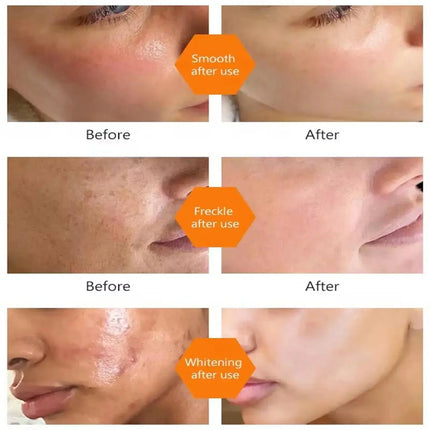 Vitamin C Whitening Serum – Dark Spot & Freckle Remover - Glossorea