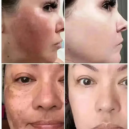 Vitamin C Whitening Serum – Dark Spot & Freckle Remover - Glossorea