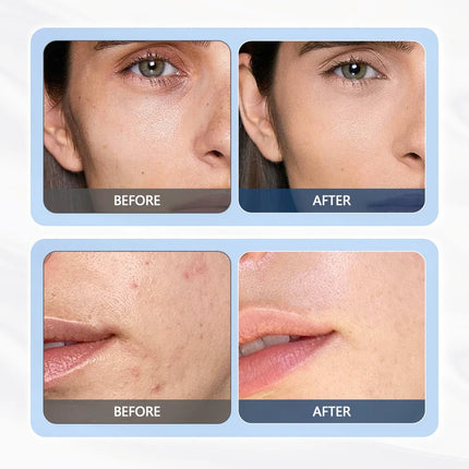 Foreverlily Ultrasonic Facial Machine – Lifting, Tightening & Pore Cleansing - Glossorea