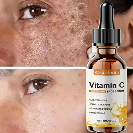 Vitamin C Whitening Serum – Dark Spot & Freckle Remover - Glossorea